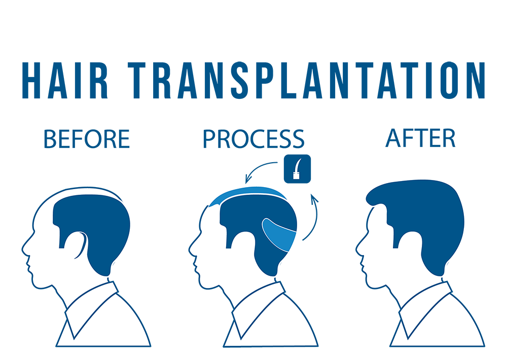 hair transplant clinic panipat,hair transplant panipat,hair transplant clinic jammu,hair transplant clinic ranchi,hair transplant clinic karnal,hair transplant,hair transplant clinic patna,hair transplant clinic kurukshetra,best hair transplant surgeon panipat,hair transplant cost panipat