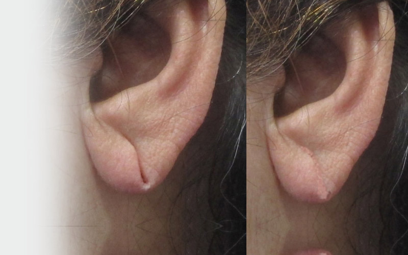 Earlobe Repair - Cosmetic Dermatologist Dr. Jason Emer