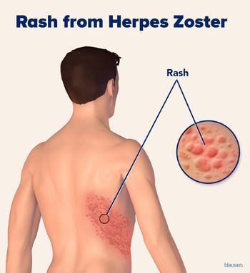 herpeszoster rashes