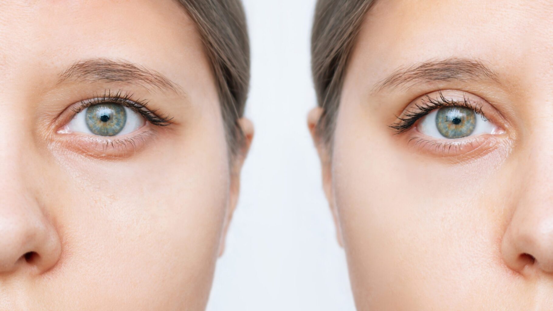 blepharoplasty